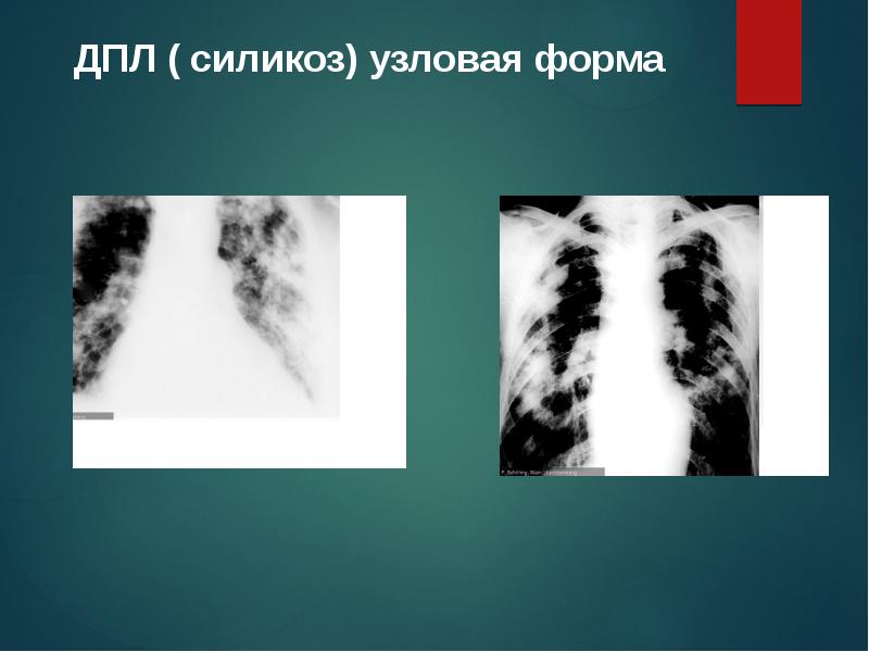 Нехарактерным для клинической картины неосложненного силикоза является