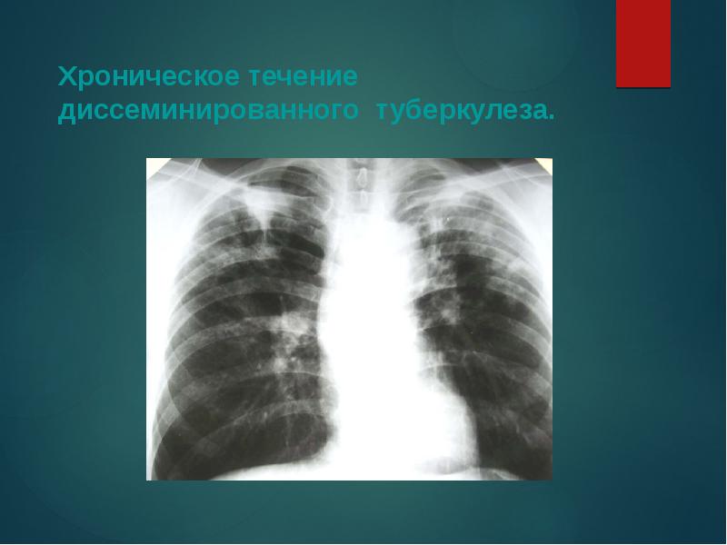 Диссеминированное поражение легких. Течение хронического диссеминированного туберкулеза легких. Хронический диссеминированный туберкулез легких. Диссеминированный туберкулез легких.