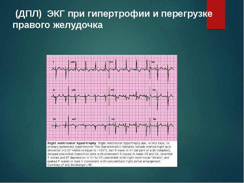 Перегрузка левого желудочка. ЭКГ критерии гипертрофии желудочков. Гипертрофия правого желудочка на ЭКГ. Гипертрофия правого желудочка с систолической перегрузкой. ЭКГ синдром гипертрофии желудочков.