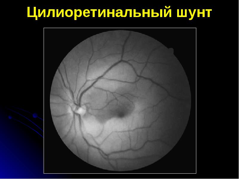 Возрастная макулярная дегенерация презентация