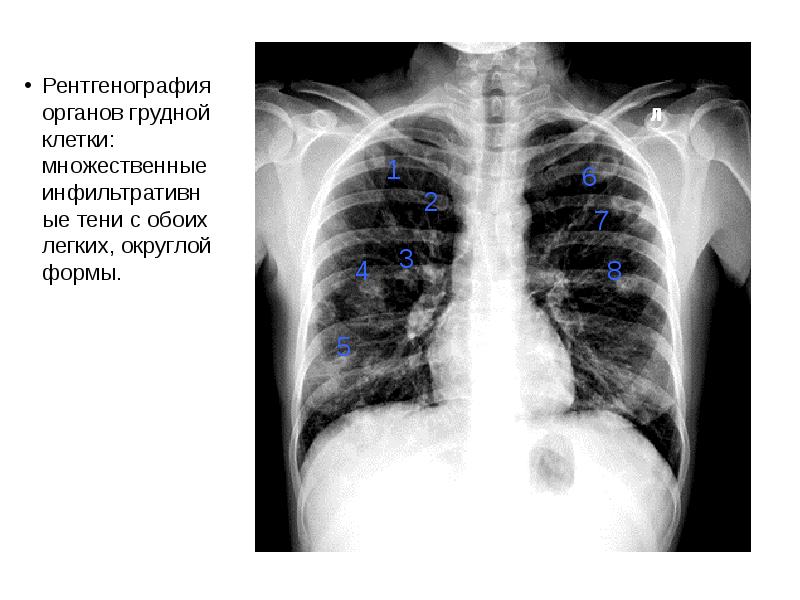 Рентгенография органов грудной клетки. Оценка рентгенограммы органов грудной клетки. Инфильтративные тени в легких что это. Рентгенограмма органов грудной клетки с тенью.