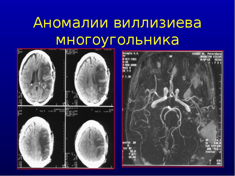 Передача аномалии. Аномалии виллизиевого круга кт. аномалии виллизиевого круга. аномалии виллизиева круга.