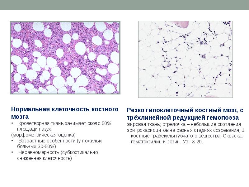 апластическая анемия трепанобиопсия. апластическая анемия красный костный мозг. жировая ткань костного мозга. апластическая анемия патанатомия. клточность комтртго мозга.