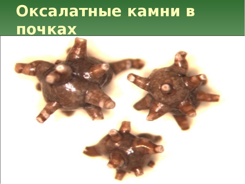 Сестринская помощь при мочекаменной болезни презентация