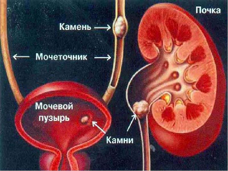 Сестринская помощь при мочекаменной болезни презентация