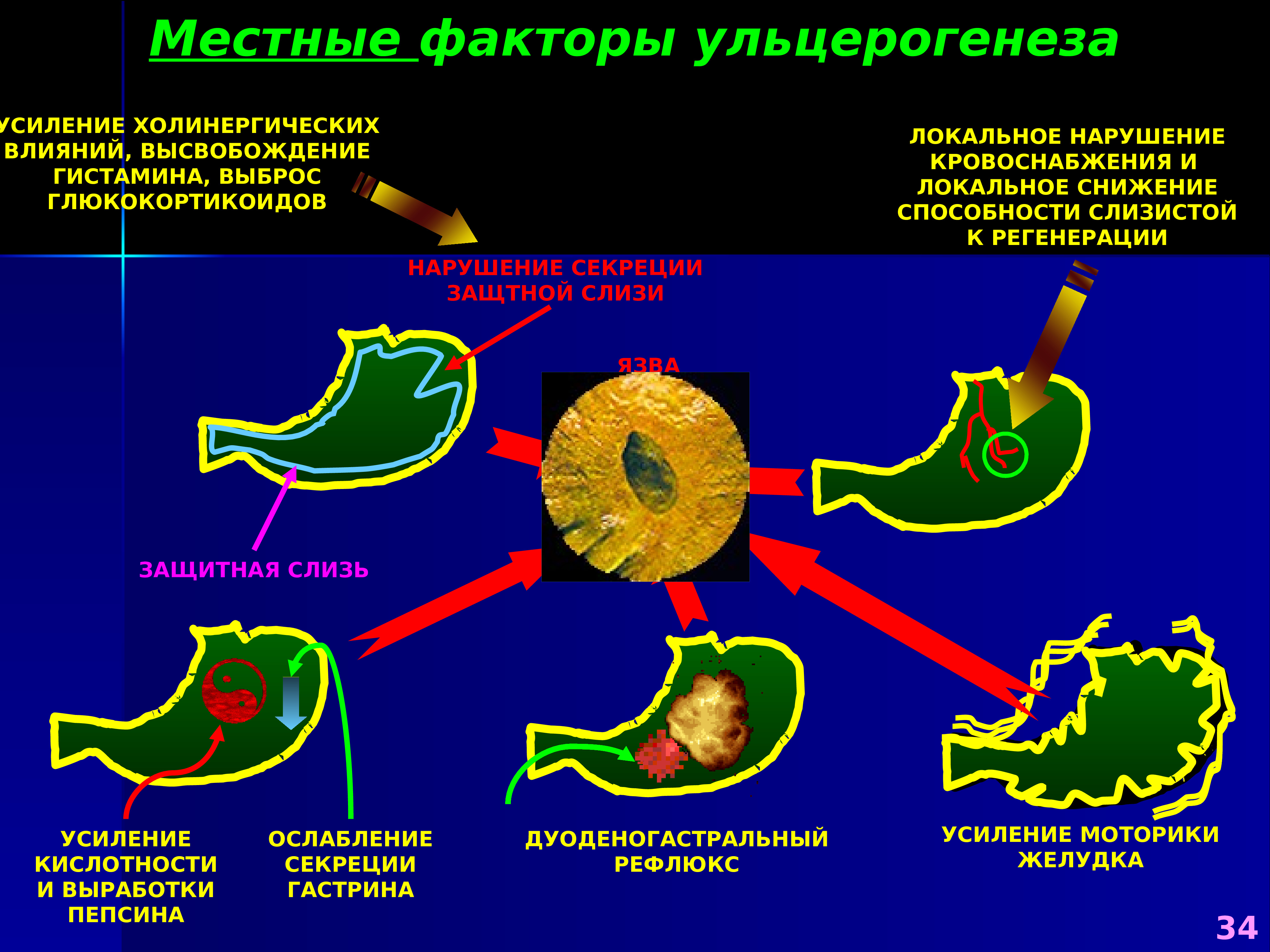 Ульцерогенез. Местные факторы ульцерогенеза. Основные этиологические факторы ульцерогенеза.. Ульцерогенез это в патологии. Теории ульцерогенеза.