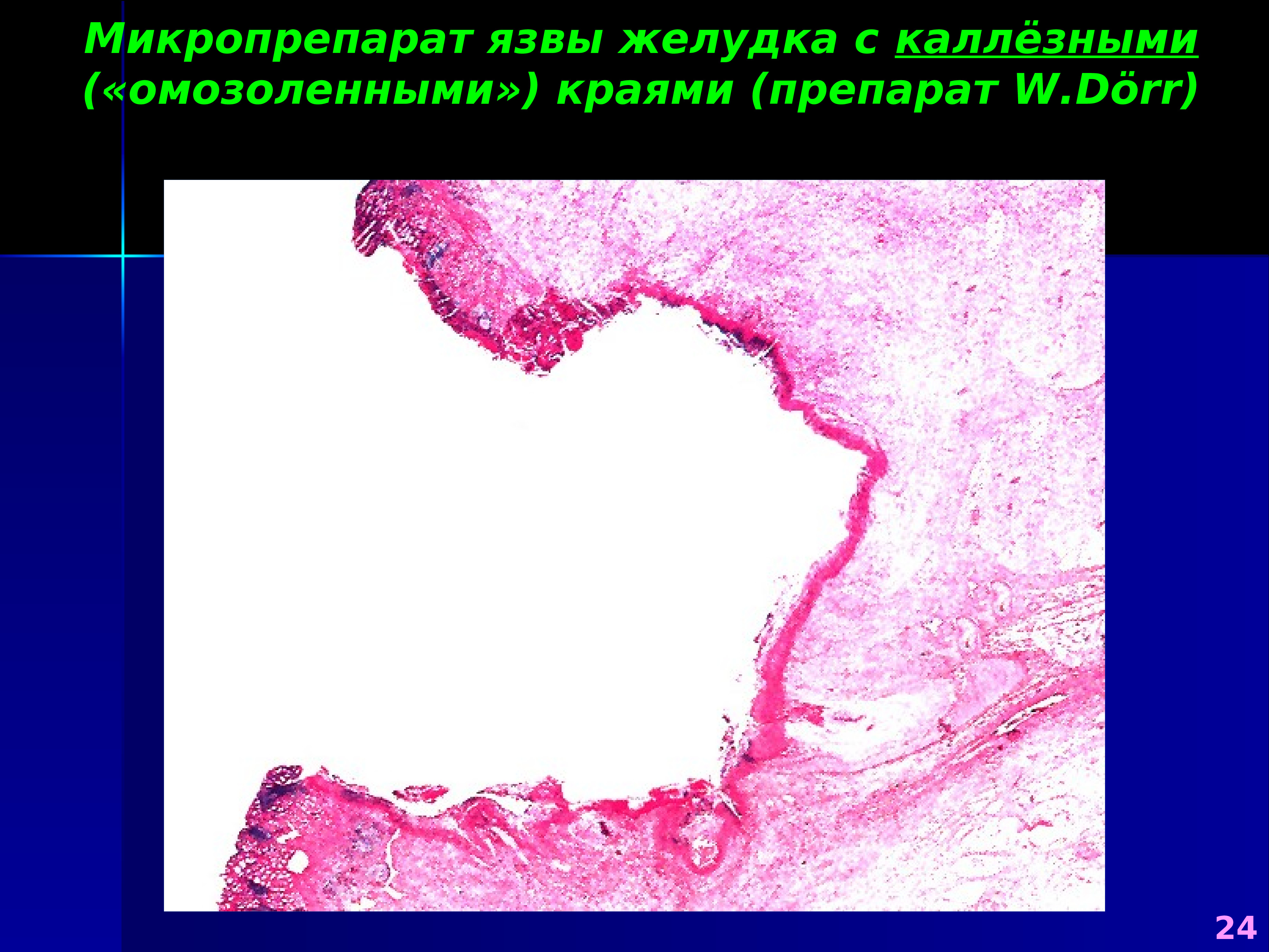 Язва микропрепарат. Каллезная язва желудка микропрепарат. Язвенная болезнь микропрепарат. Язва желудка микропрепарат патанатомия. Каллезная язва гистология.