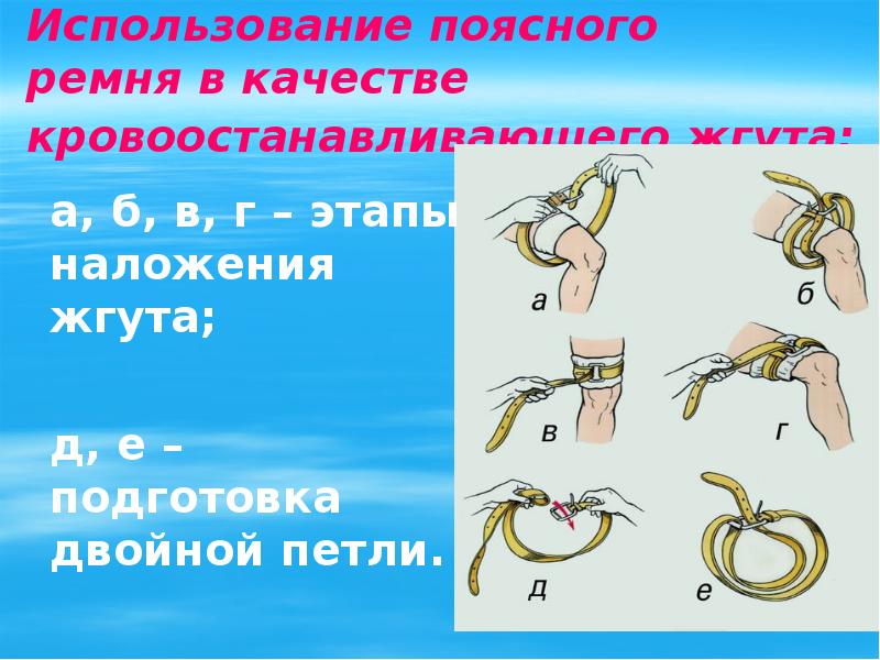 На какой срок накладывают кровоостанавливающий жгут. Принципы использования поясного ремня в качестве жгута. Поясный ремень в качестве кровоостанавливающего жгута. Наложение жгута из ремня.