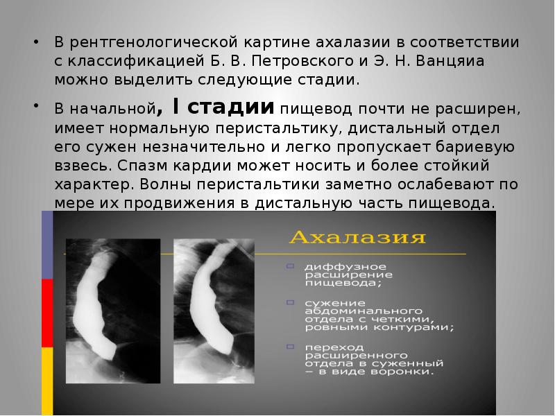 Ахалазии кардии презентация