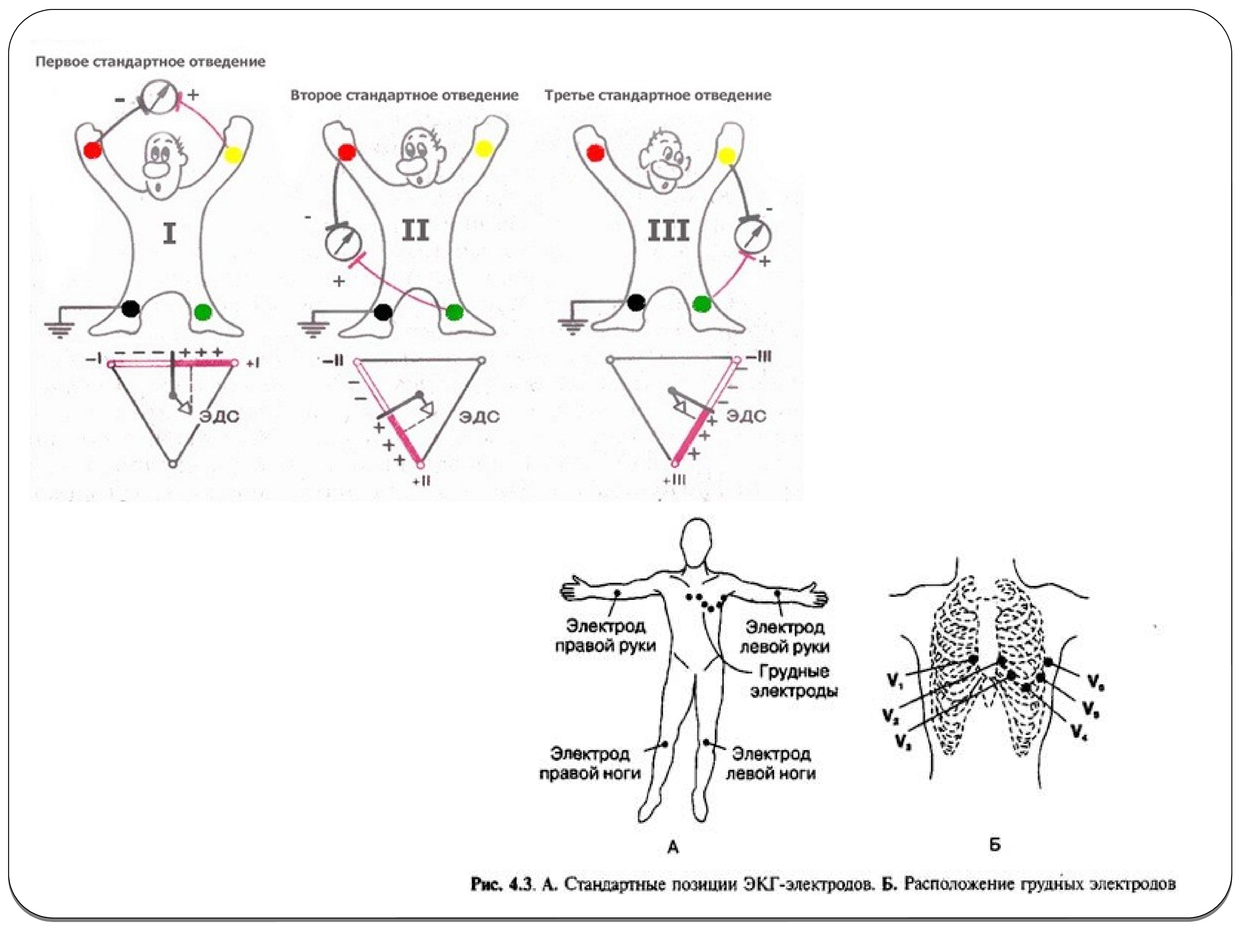 Электроды экг стандартные отведения. Наложение электродов при ЭКГ стандартные отведения. Электроды ЭКГ схема наложения. Схема грудных электродов ЭКГ. Схема подключения электродов ЭКГ.