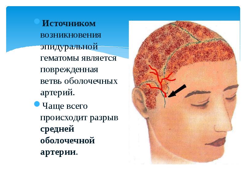 Гематома локальный статус. Черепно-мозговая травма. Открытая черепно-мозговая травма. Средняя оболочечная артерия.