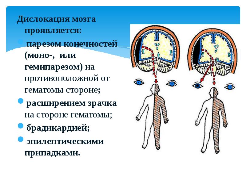 Дислокация мозга проявляется. ДЦП левосторонний гемипарез. Легкая степень гемипареза. Гемипарез лечение