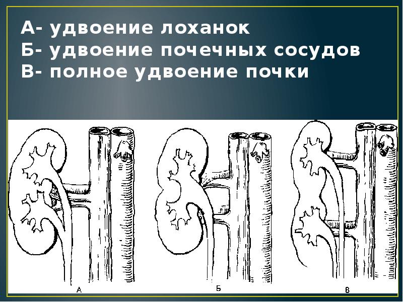 Аномалии мочеполовой системы презентация