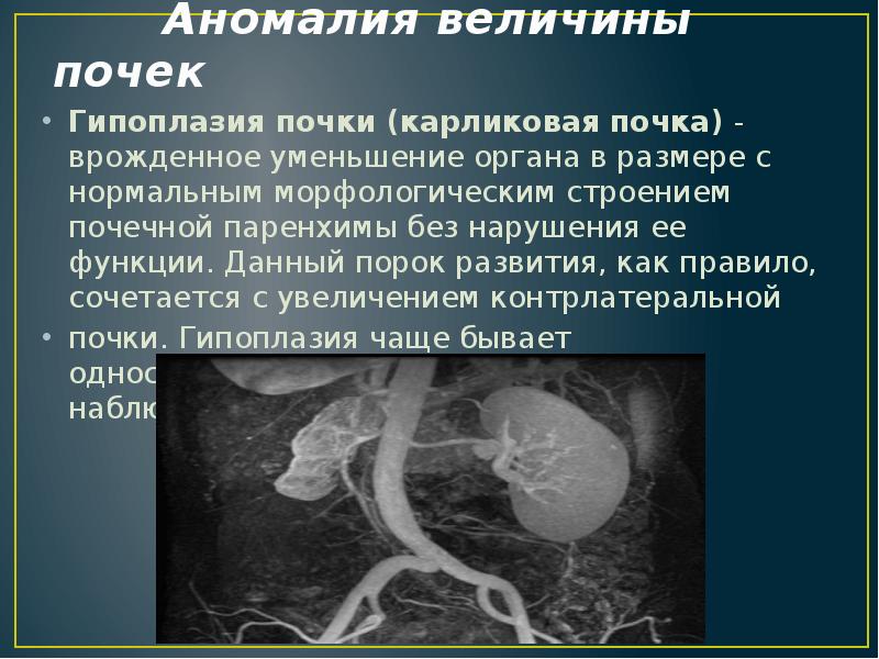 Аномалии мочеполовой системы презентация