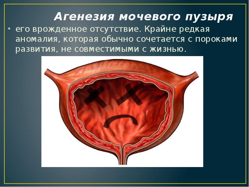 Аномалии мочеполовой системы презентация