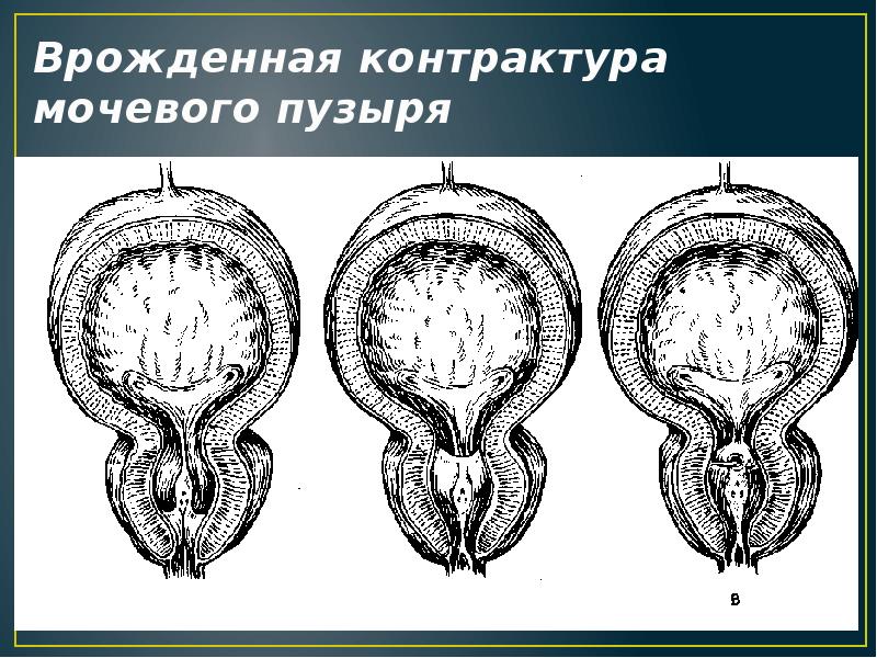 Аномалии мочеполовой системы презентация