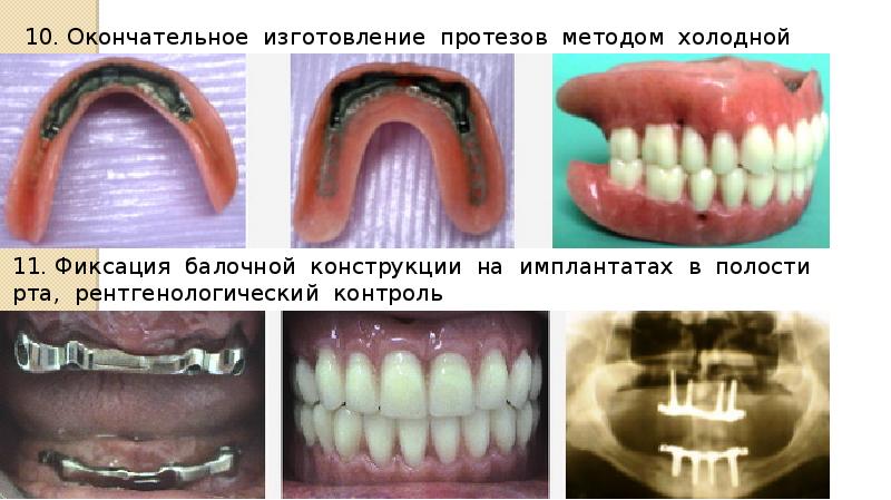 Протезирование на имплантатах общие принципы презентация