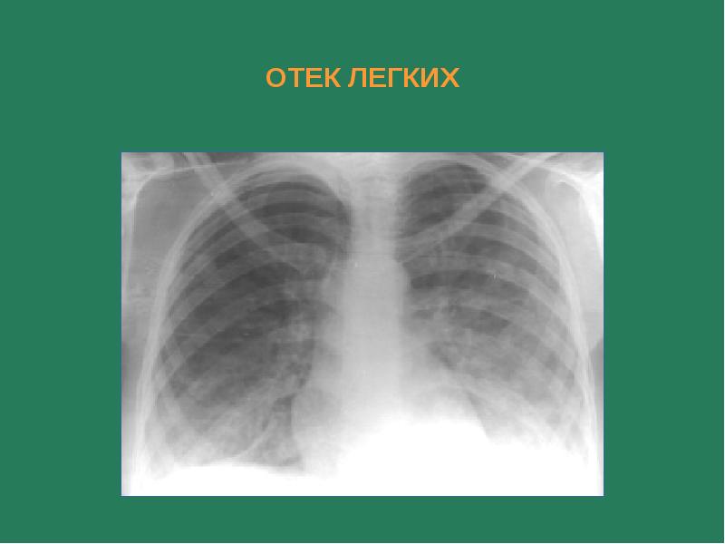 Рентгенологическая картина отека легких