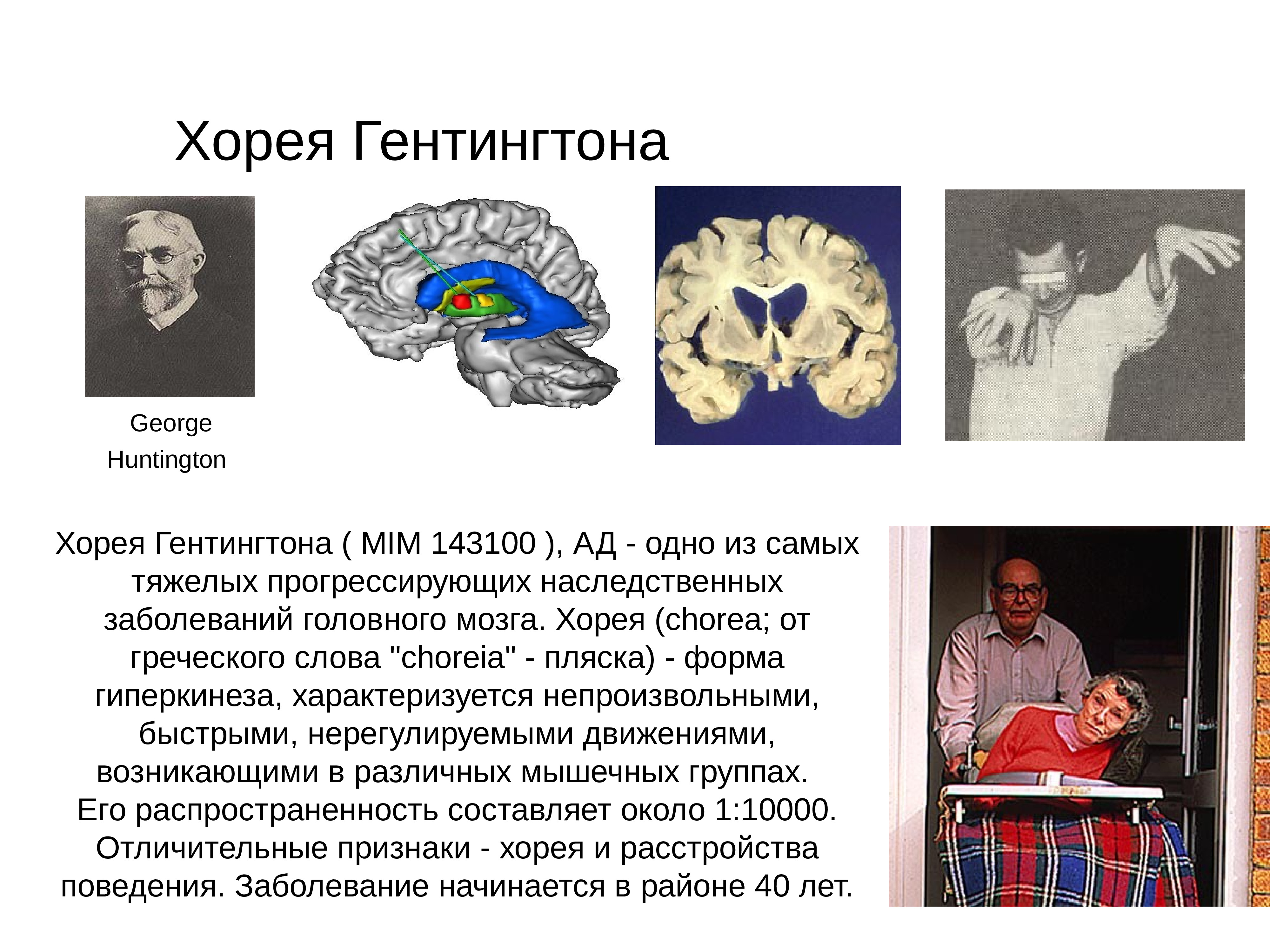 Хореи гентингтона. Болезнь Гентингтона симптомы. Болезнь Хантингтона (Хорея Гентингтона). Ювенильная форма болезни Гентингтона. Болезнь Хорея Гентингтона симптомы.