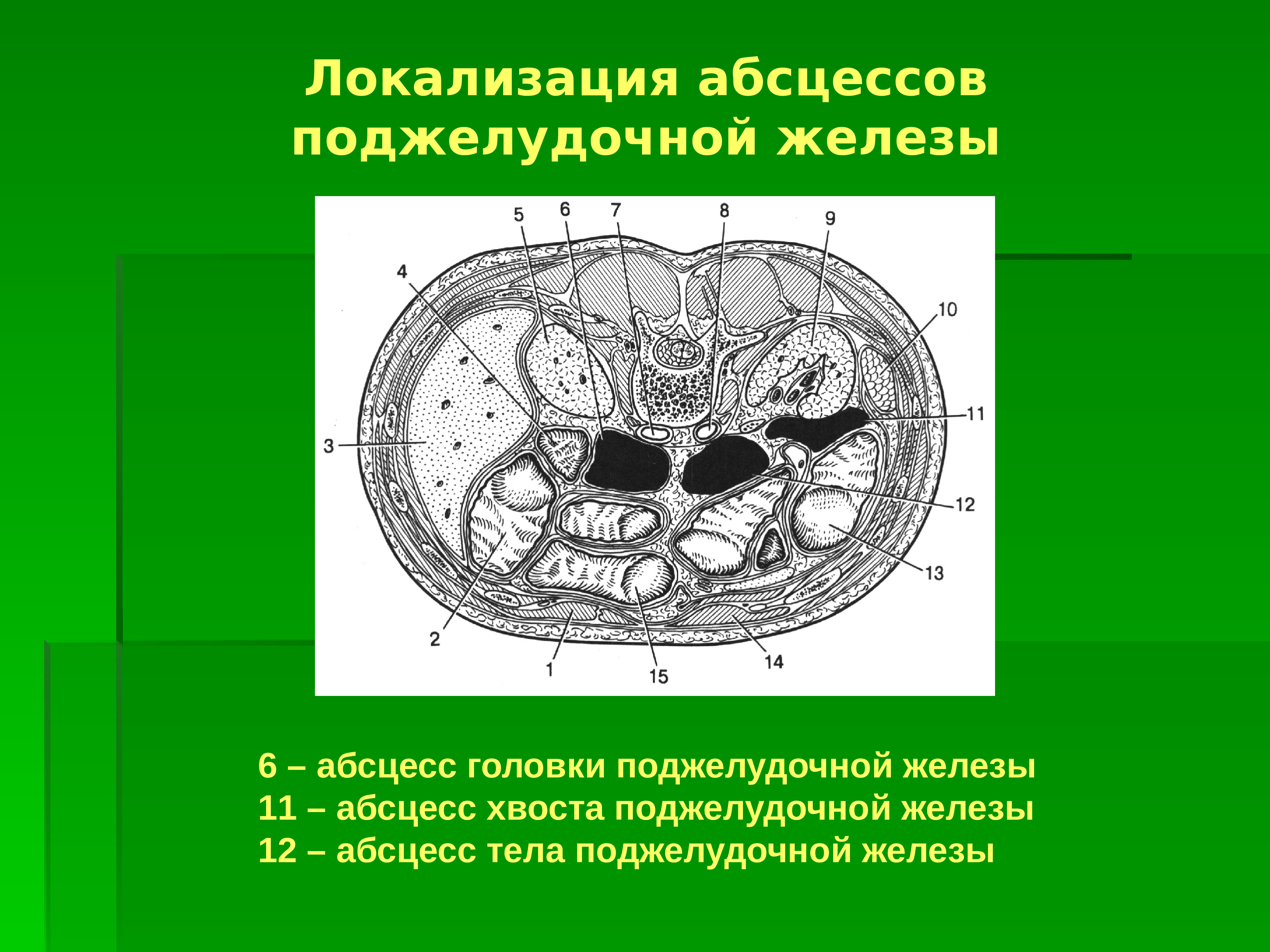 Железы головки. Абсцесс поджелудочной железы кт. Гнойник в поджелудочной железе. Абсцесс хвоста поджелудочной железы. Абсцесс головки поджелудочной железы.