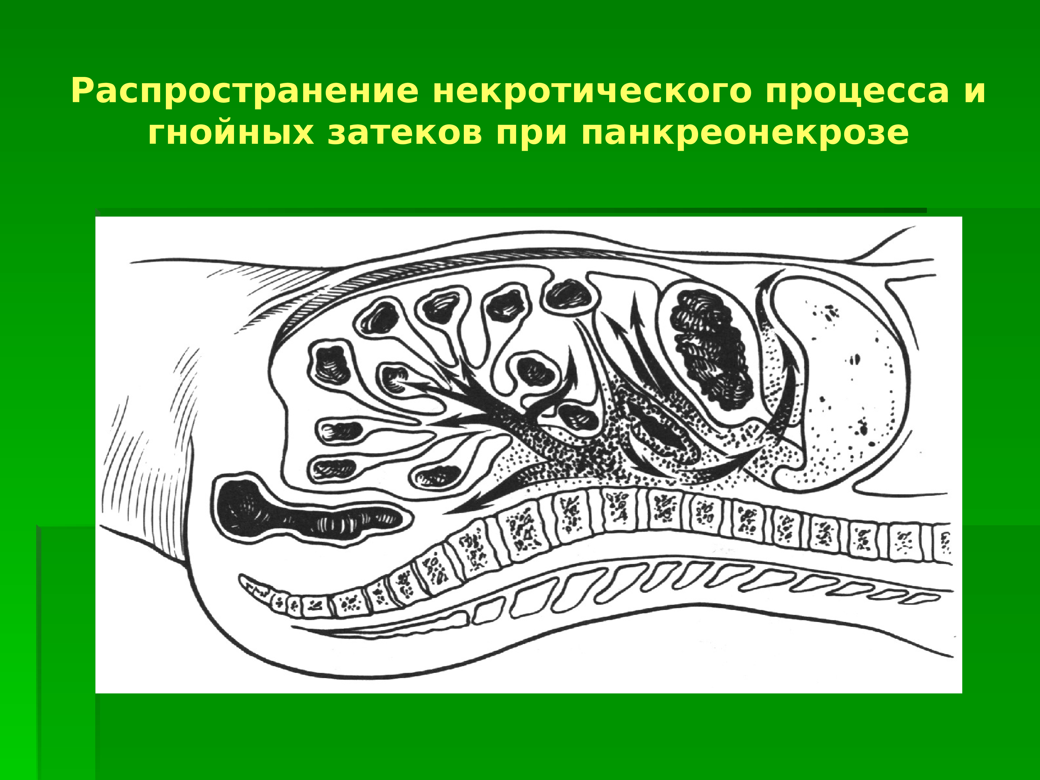 Органы распределения. Гнойные процессы в клетчаточных пространствах. Пути распространения гнойных ЗАТЕКОВ. Забрюшинное пространство распространение гнойных процессов. Клетчаточные пространства, пути распространения гнойных ЗАТЕКОВ,.