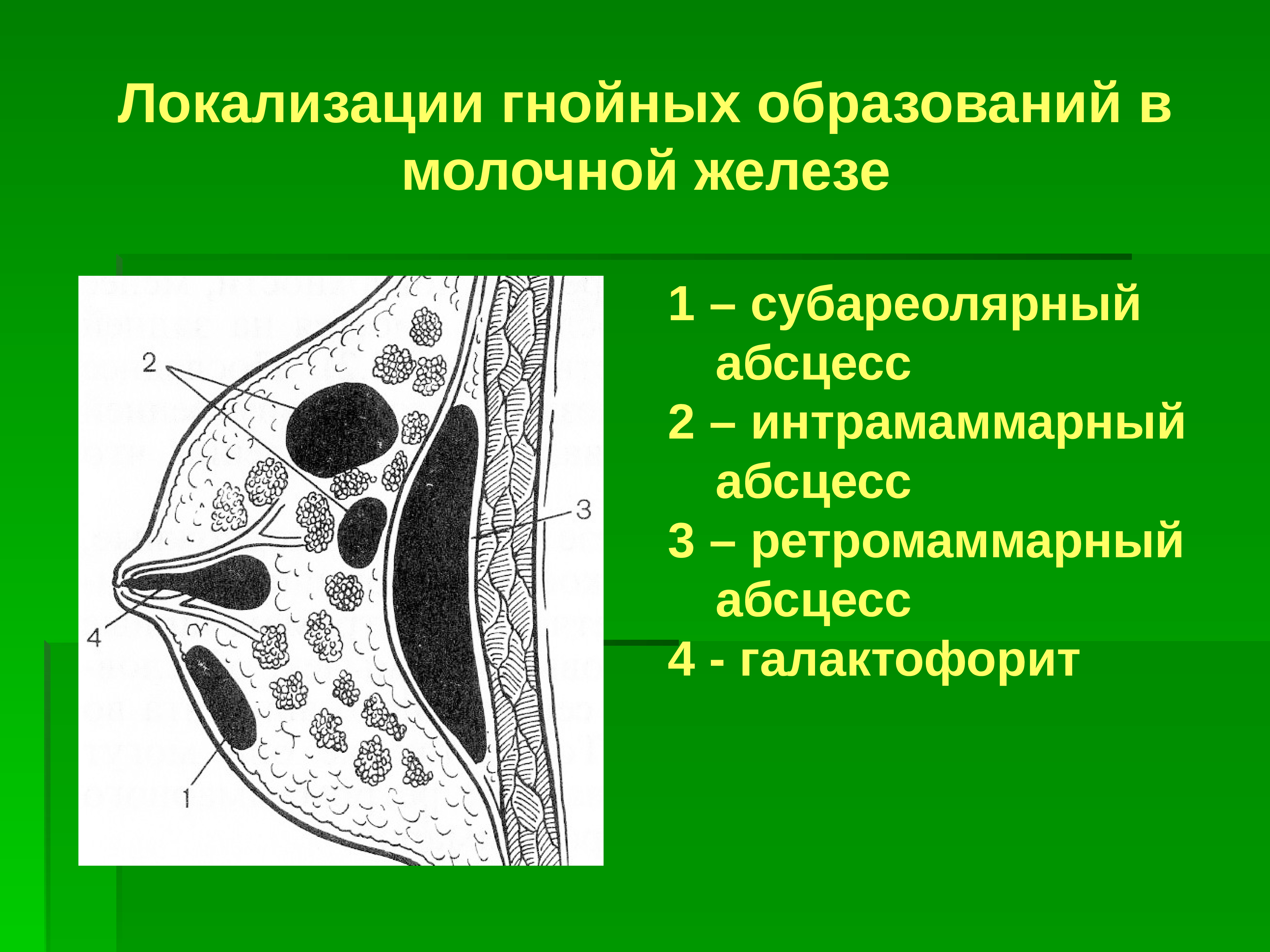 Желез молока. Интрамаммарный абсцесс молочной железы. Ретпомамарное коетчатое пространство. Локализация абсцессов молочной железы. Субареолярный абсцесс.