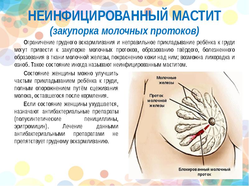 Лактостаз при грудном вскармливании. Закупорился проток молочной железы. Закупоривание молочных протоков. Закупорка молочного протока. Болит грудь при лактации.