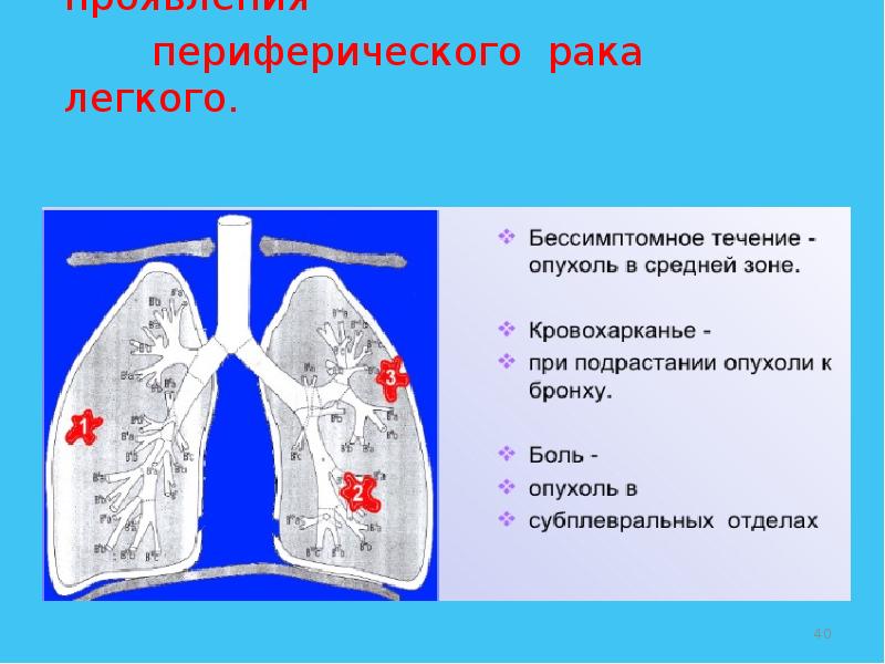 Частая локализация. Периферические отделы легких. Субплевральные отделы легких. Периферический отдел легкого.