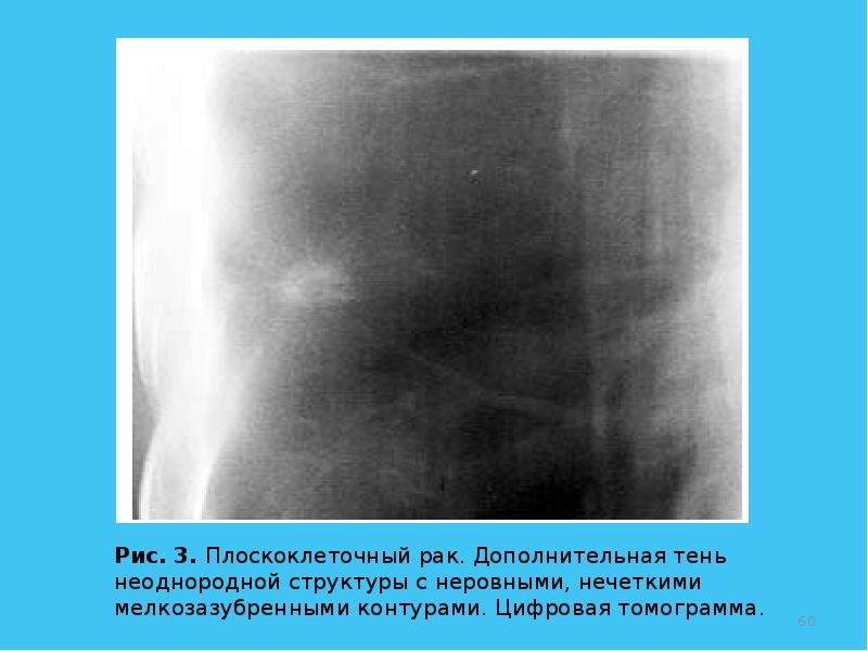 подкапсульная гематома печени на узи. гиперэхогенное фиброаденома. контуры неровные нечеткие. узел щитовидной железы с микрокальцинатами. контуры неровные нечеткие.
