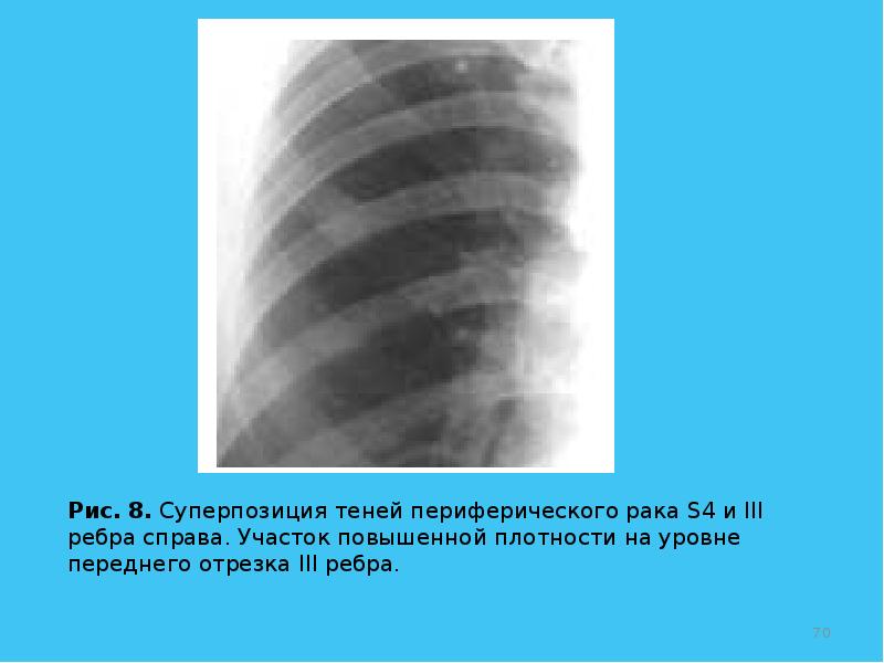 Мелкие очаговые тени в легких это. Плотные тени в легком. Очаговые тени в легких. Плотные тени в легком. Очаговые тени в легких на рентгене.