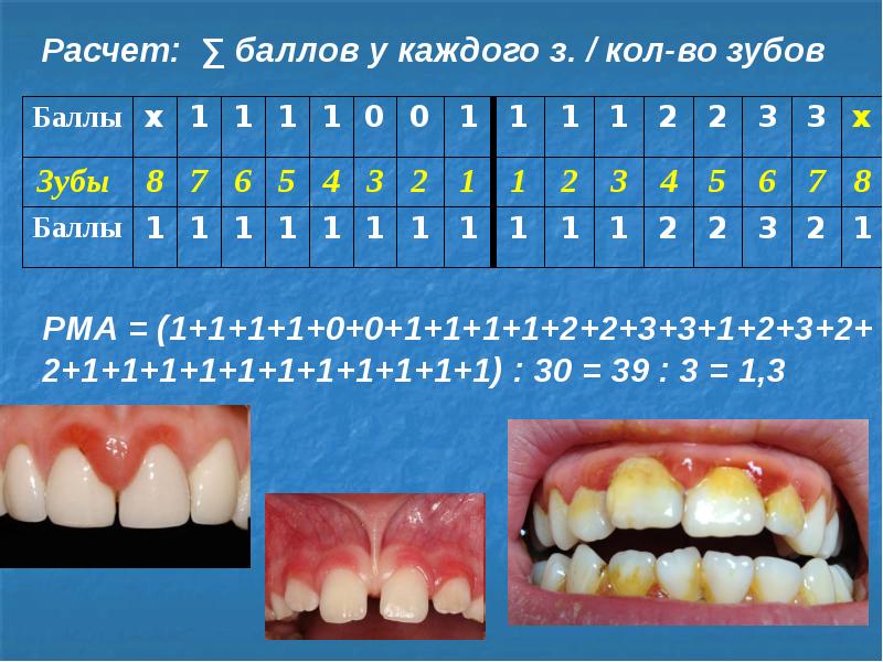 Индексная оценка состояния тканей пародонта презентация