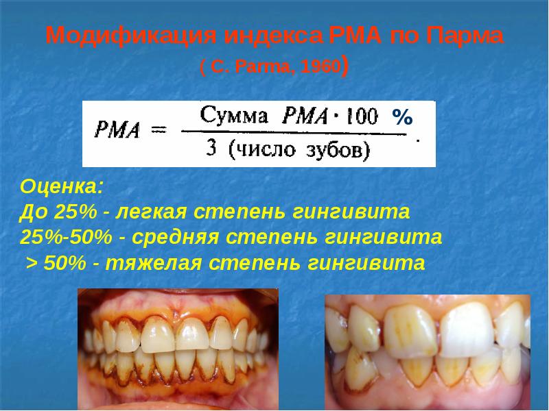 Оценка пародонта. Катаральный гингивит индекс. Индекс РМА. Индекс PMA. Индекс PMA В стоматологии.