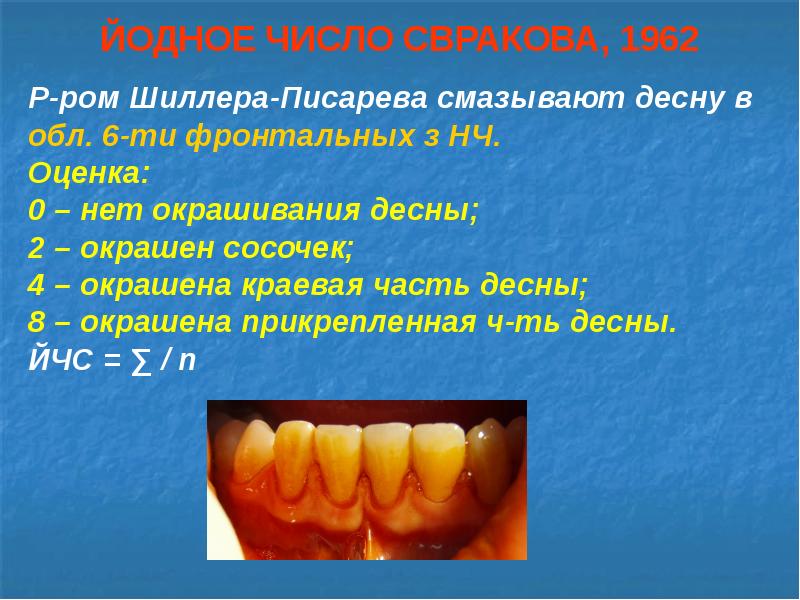 Состояние тканей пародонта. Окрашивание зубов раствором Шиллера Писарева. Десна окрашенная раствором Шиллера-Писарева. Проба Шиллера Писарева пародонтит. Проба шилероа пи Сарева.