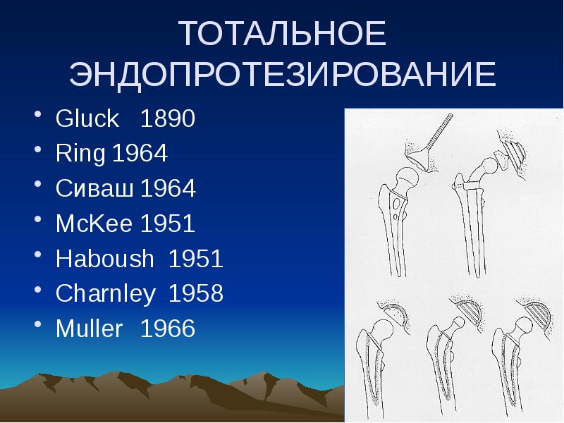 Эндопротезирование тазобедренного сустава презентация