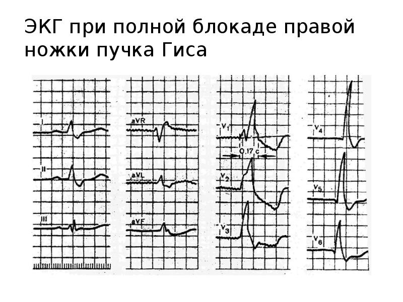 Полная блокада правой ножки гиса