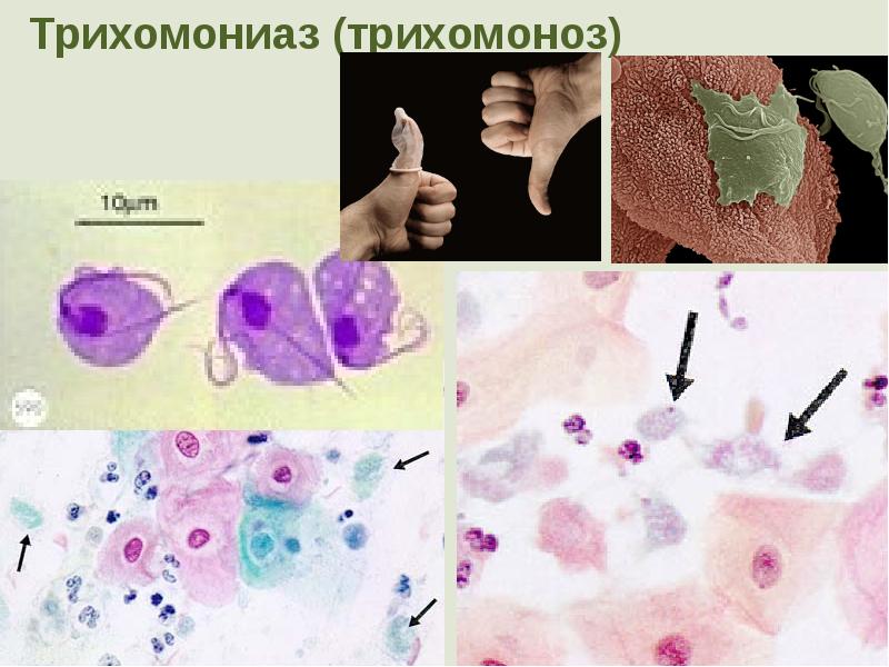 Урогенитальный трихомониаз презентация