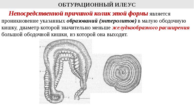 Паралитический илеус