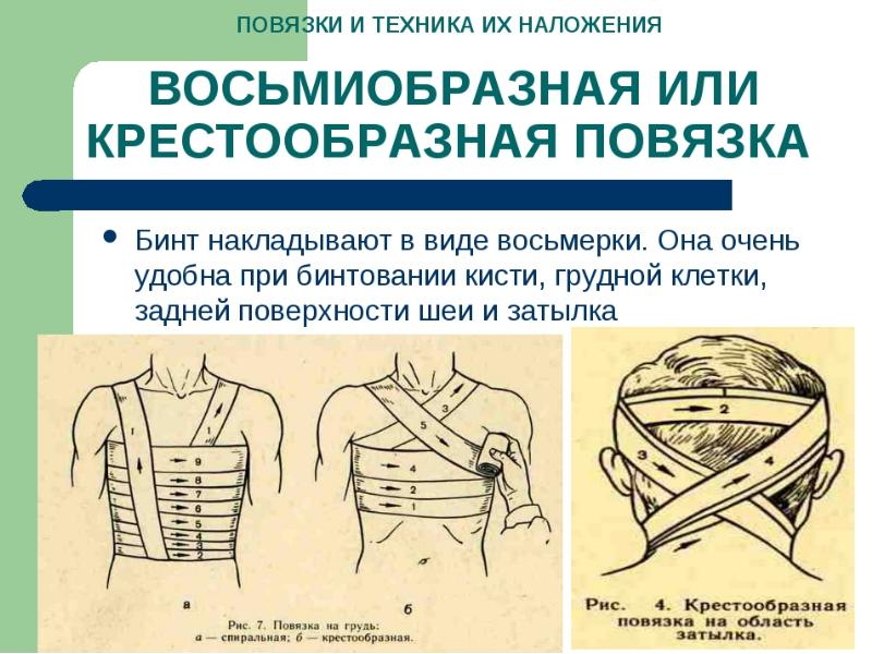 Виды повязок и способы их наложения презентация