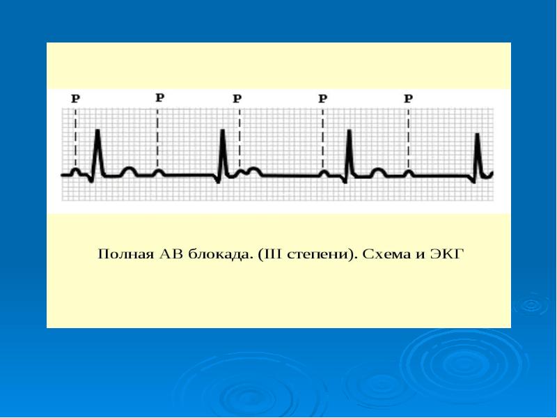Ав блокада сердца 1 степени. АВ блокада. АВ блокада различия правой и левой.