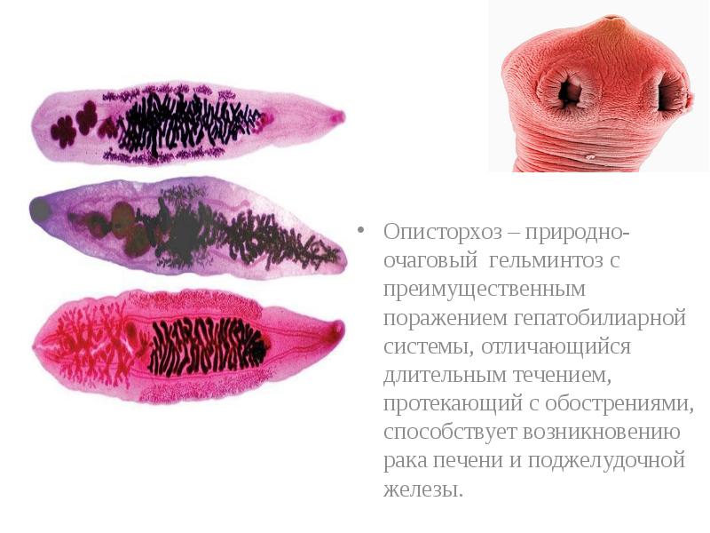 Описторхоз