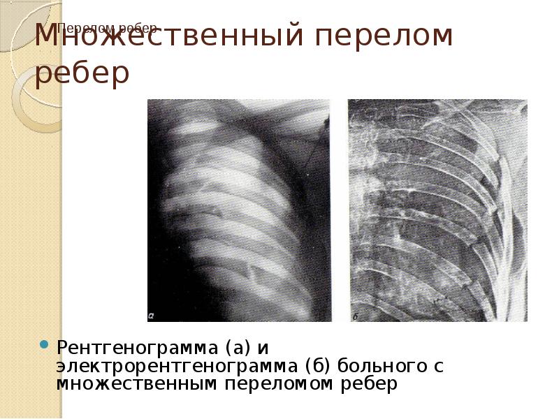 Травмы грудной клетки презентация