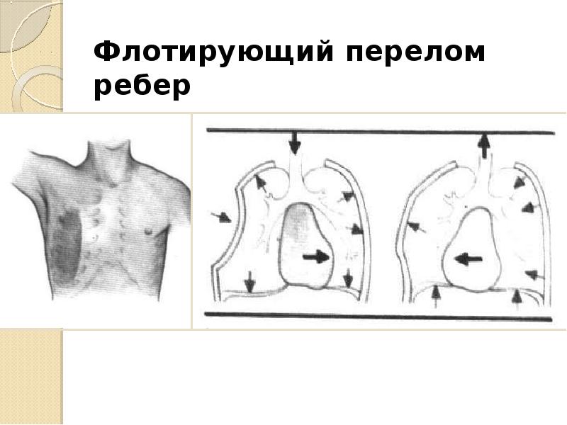 Презентация повреждения грудной клетки