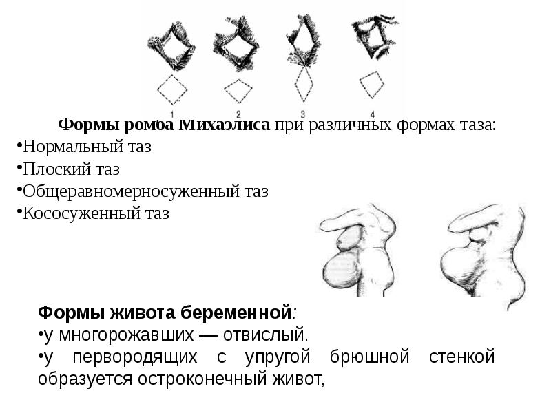 Аномалии таза презентация