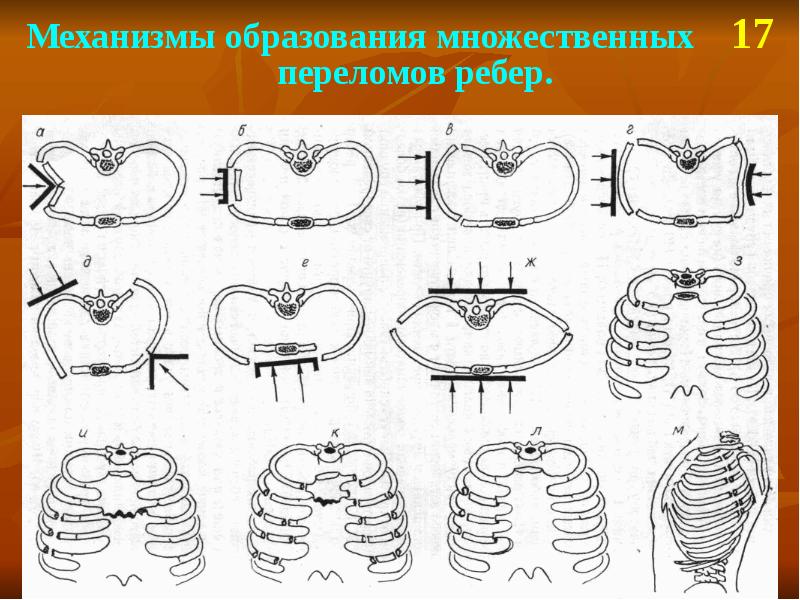 Переломы ребер презентация