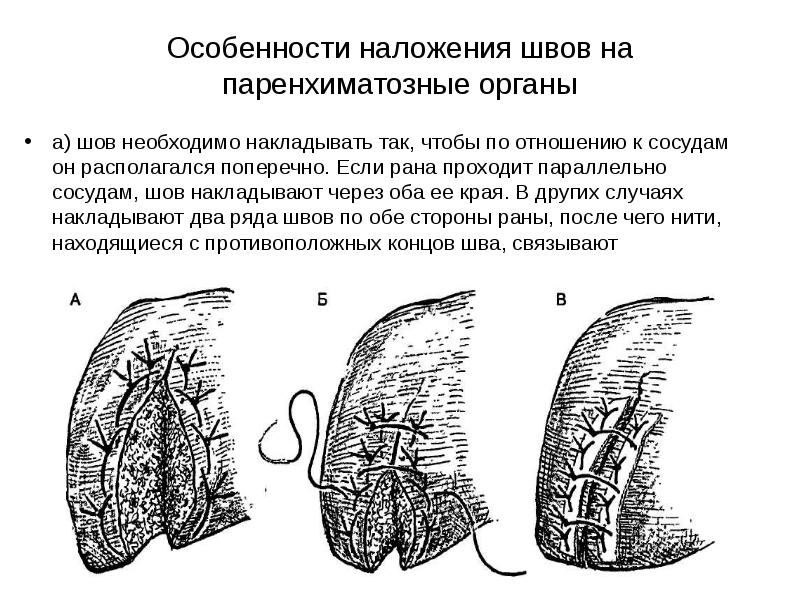 шов паренхиматозных органов. ушивание ран печени, шов кузнецова-пенского. печеночный шов кузнецова-пенского. шов паренхиматозных органов. гемостатический шов кузнецова-пенского (схема).