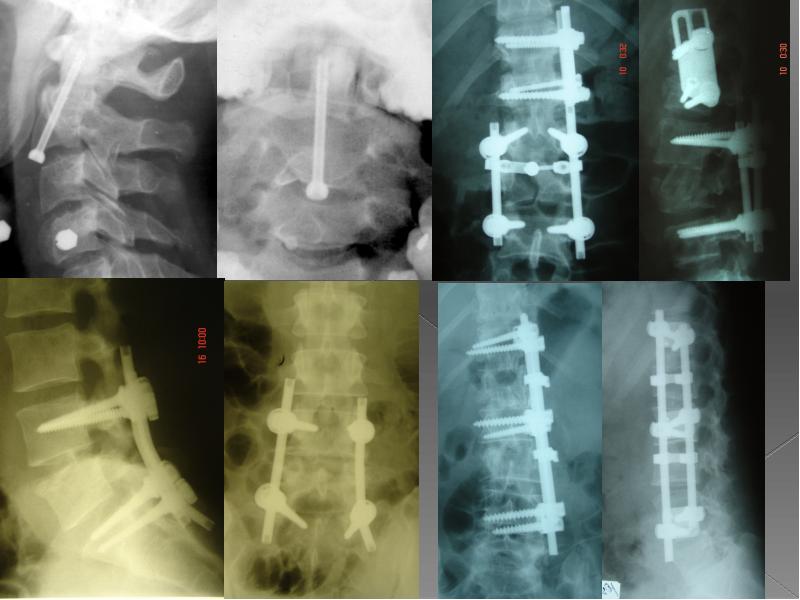 Переломы позвоночника презентация травматология