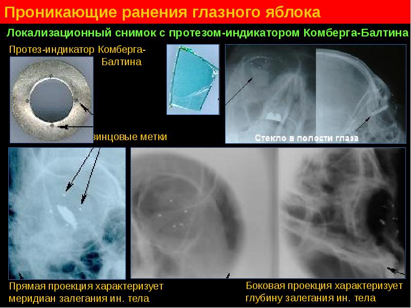 Инородное тело глаза карта смп - 97 фото