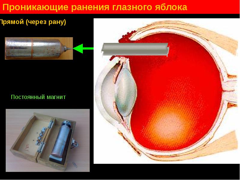 Пр никнуть. Проникающая рана глазного яблока. Непроникающие ранения глазного яблока. Признаки проникающего ранения глазного яблока.