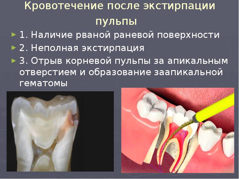 Хронический пульпит презентация