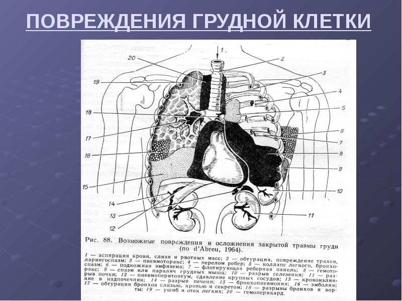 Повреждение грудной клетки презентация